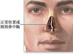 睾丸炎手术安全吗？